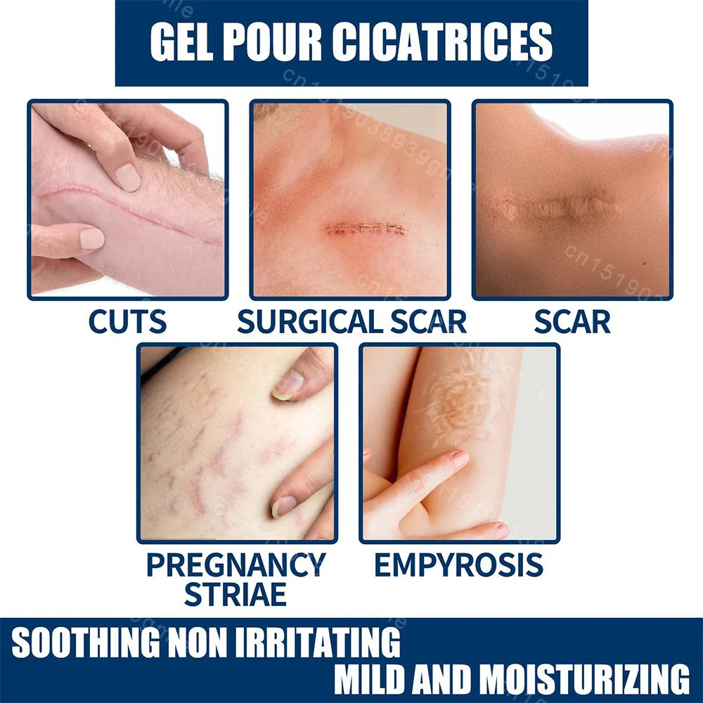 Recovery Scar Cream Fast Removal Skin Scars Treat Surgery Scars Stretch Marks Acne Pox Prints Burn Repair Facial Care Gel